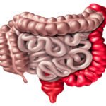Ulcerative Colitis